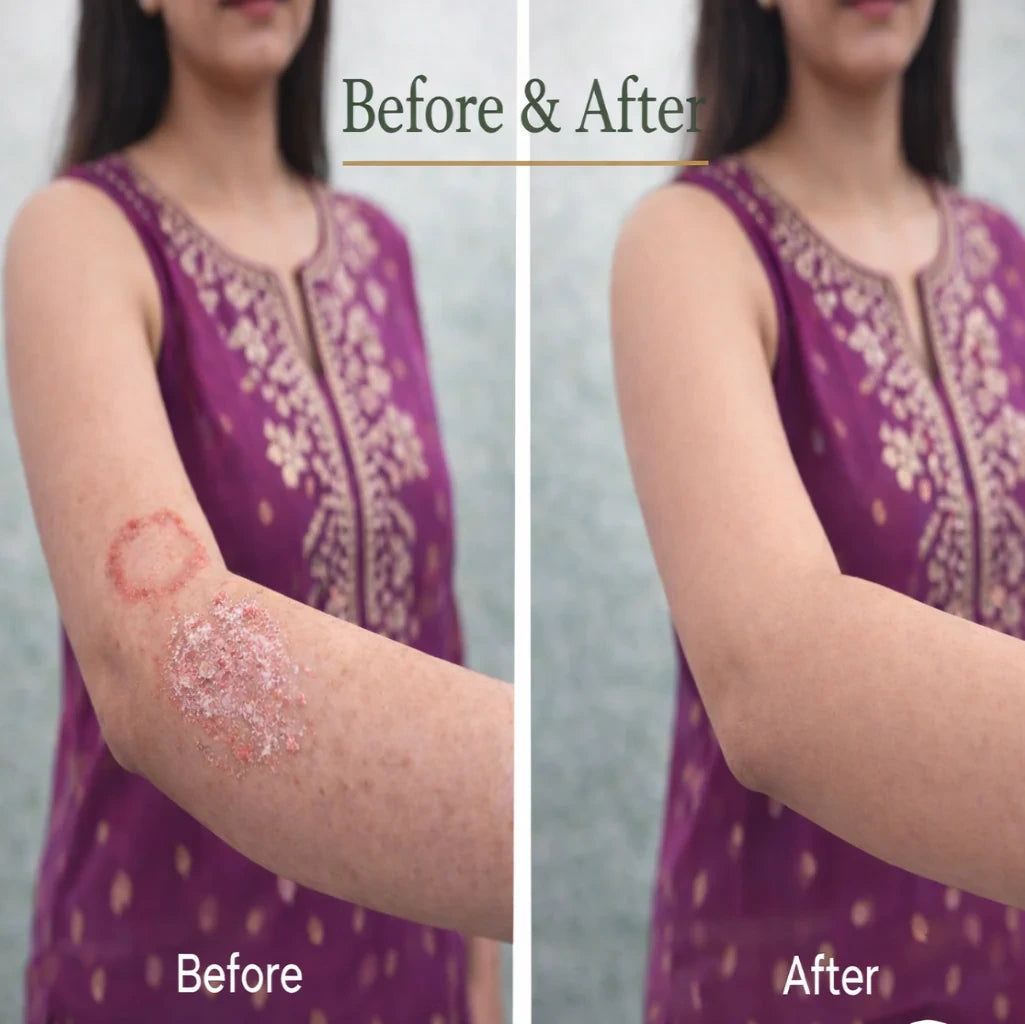 Skin Healing Herbal Cream for Psoriasis & Ringworm