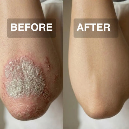 Skin Healing Herbal Cream for Psoriasis & Ringworm